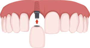 Image showing a crown being placed on a dental implant and abutment. 