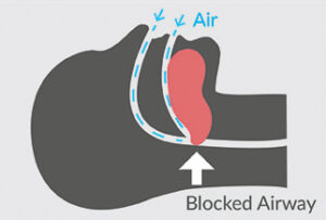 Diagram of how sleep apnea causes a blocked airway.