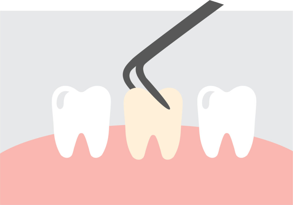 Tooth Extractin Tooth Extraction in Attleboro, MA - Mondovi Dental